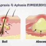 boil vs abscess